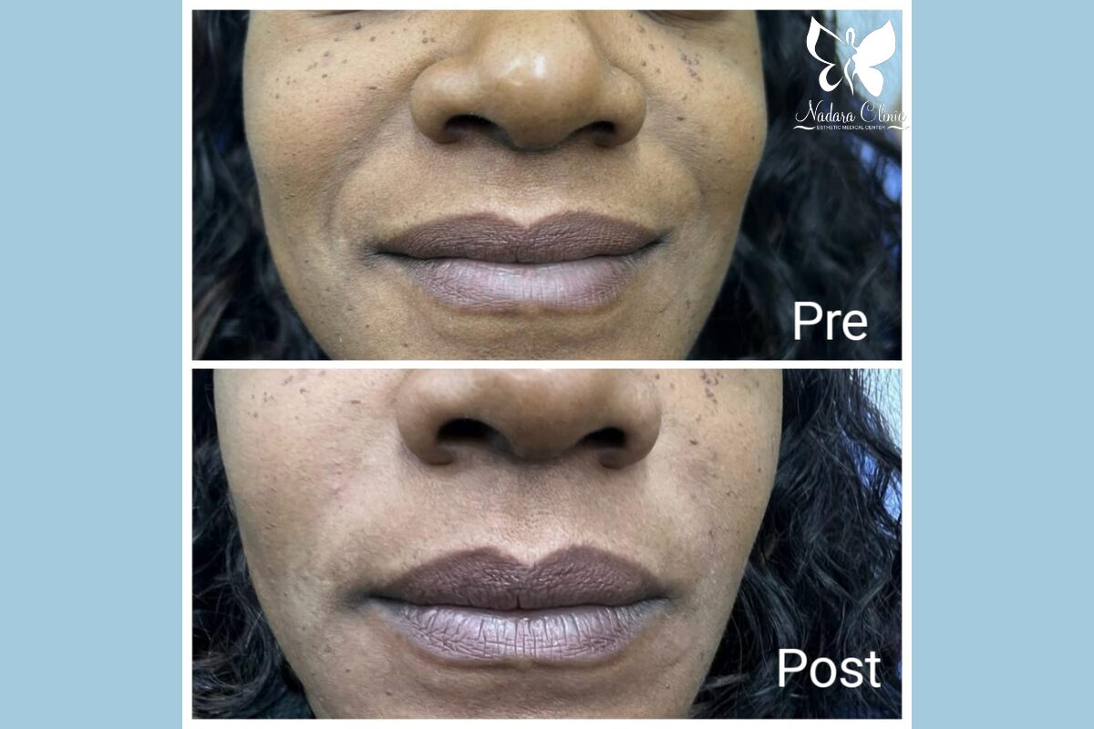 علاج خطوط الابتسام في الغردقة